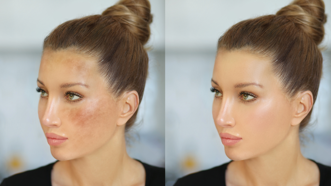 How to Visibly Fade Dark Spots: Skincare Methods Backed by Research