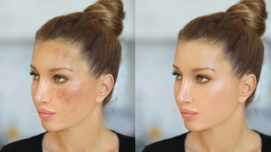 How to Visibly Fade Dark Spots: Skincare Methods Backed by Research